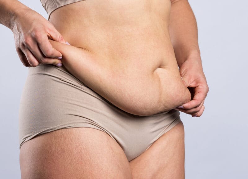 woman demonstrating the need for a tummy lift procedure
