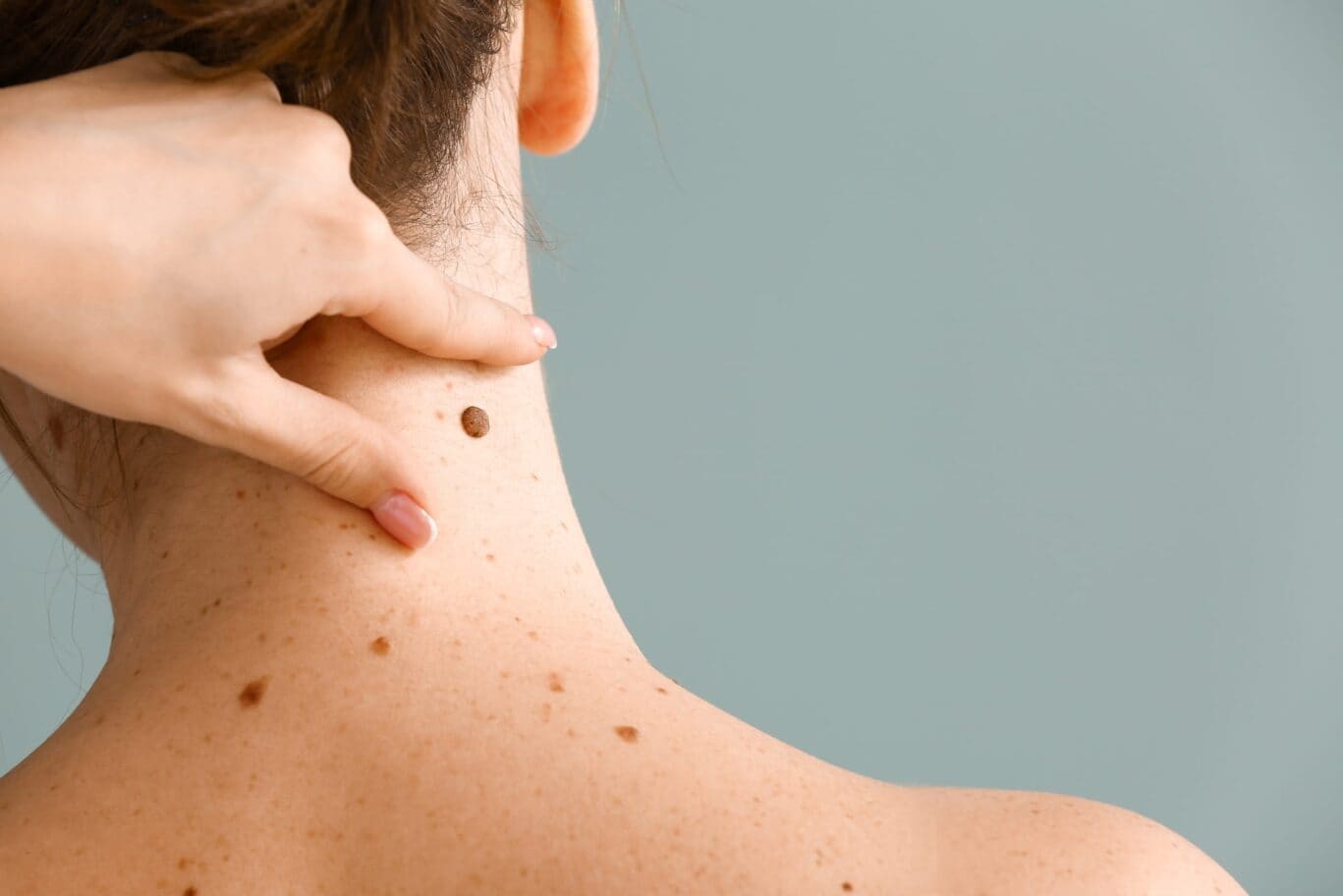 A specialist points to a large mole on the back of their neck, with several smaller moles visible on their upper back and neck against a plain blue background, highlighting areas that might be considered for plastic surgery.