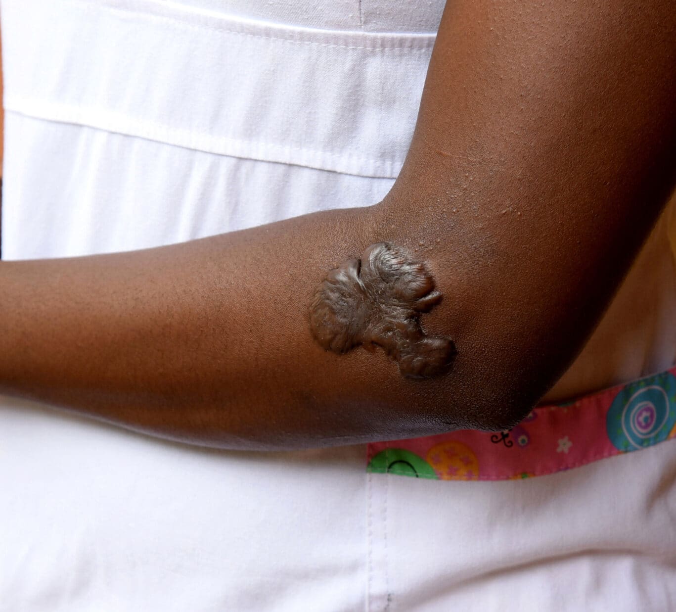 Close up of keloid scar on arm