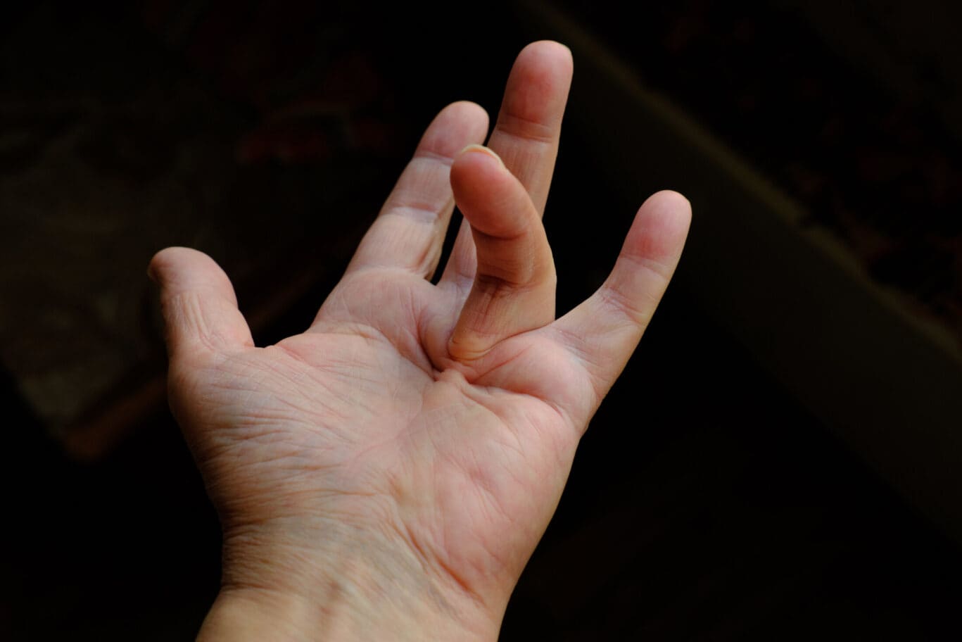 Hand of a person with Dupuytren's contracture,