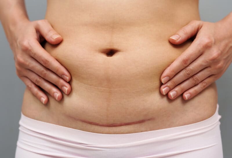 close up belly of woman with c-section scar of caesarean