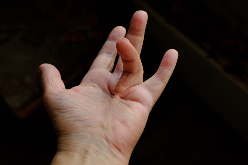 A close-up of a left hand with the middle finger bent backwards at an unusual angle, highlighting flexibility against a dark background—a view often examined by a specialist in plastic surgery.