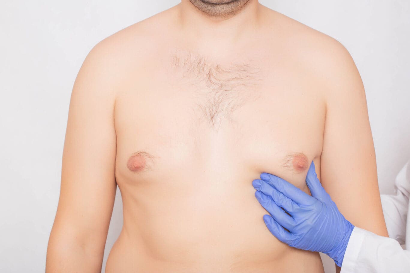 A person with a bare chest is being examined by a plastic surgery specialist wearing a blue medical glove, carefully touching the left side of the chest.