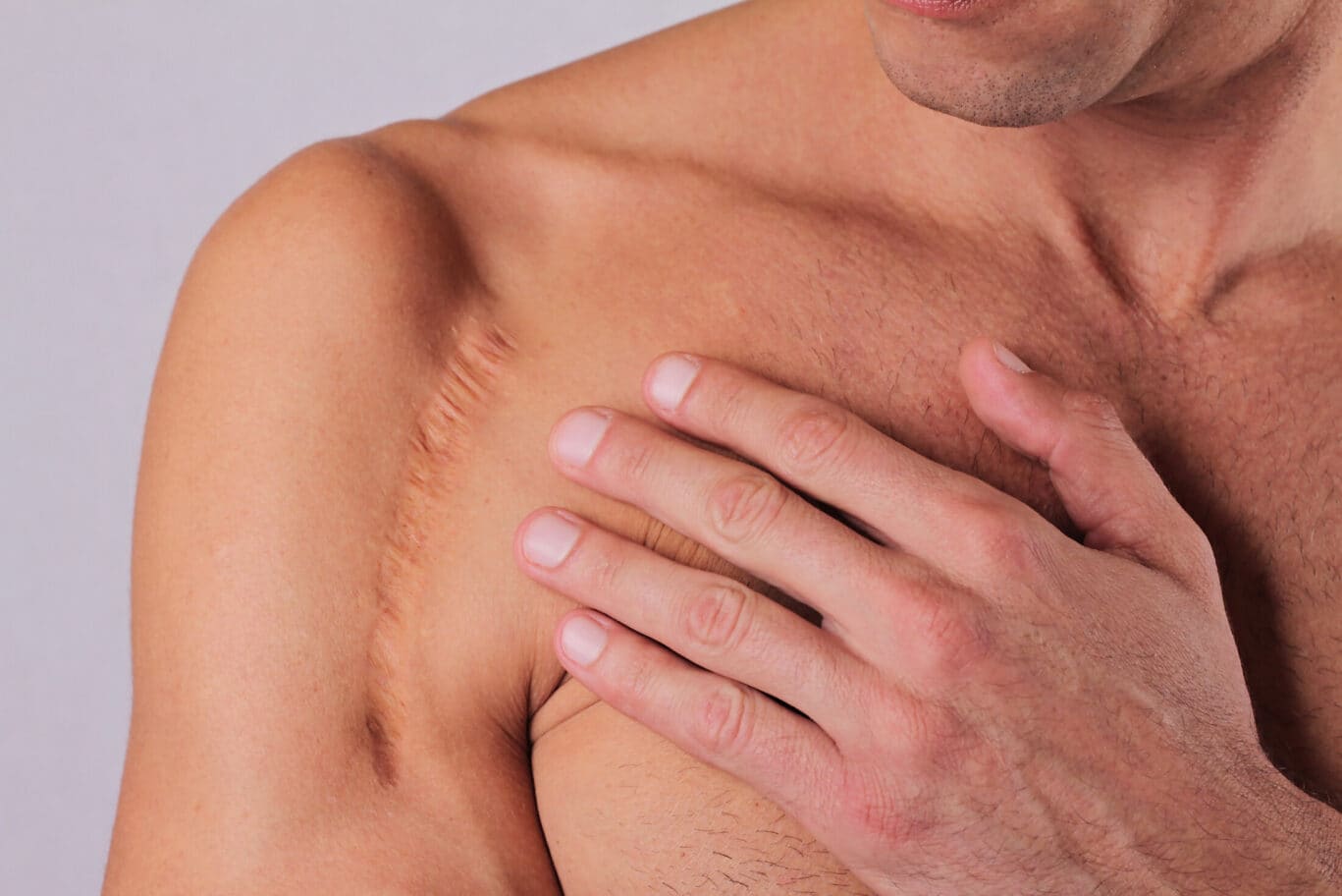 A person with short hair touches a large, healed scar on their upper chest and shoulder.