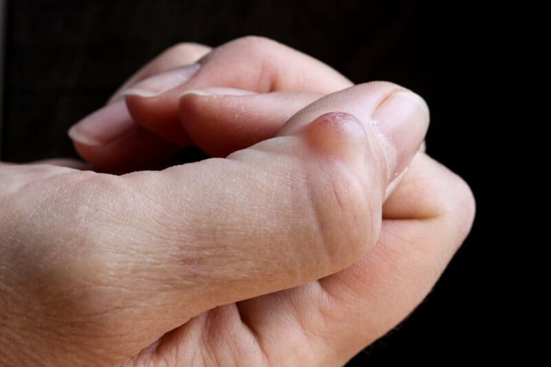 Ganglion cyst (synovial cyst disease) on the thumb of a woman’s hand. Selective focus. Considering surgery