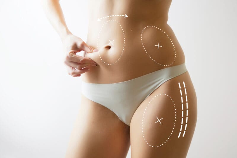 women with marks to show areas of liposuction. Considering liposuction.